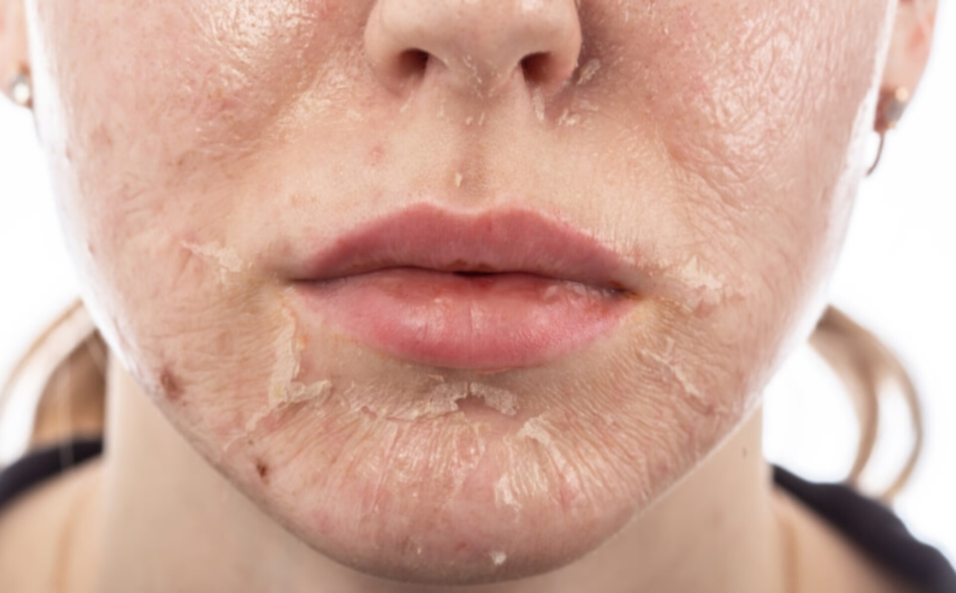 اسید تراپی تخصصی درمان لک و جوش در تهران با تخفیف ویژه | سالن زیبایی بانو نیلوفر رهبر در هروی