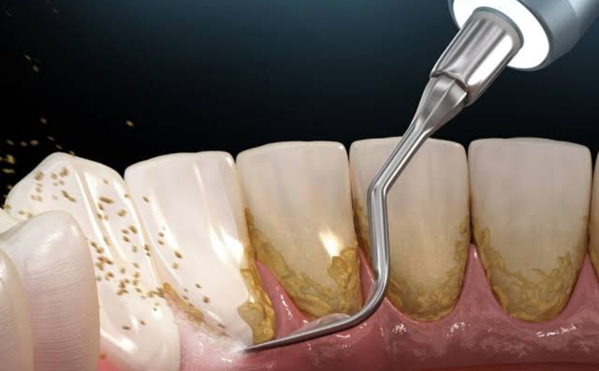 جرمگیری هر فک با تخفیف ویژه در مرکز دندانپزشکی مدرن اشرفی | باغ فیض تهران مخصوص بانوان نسل Z