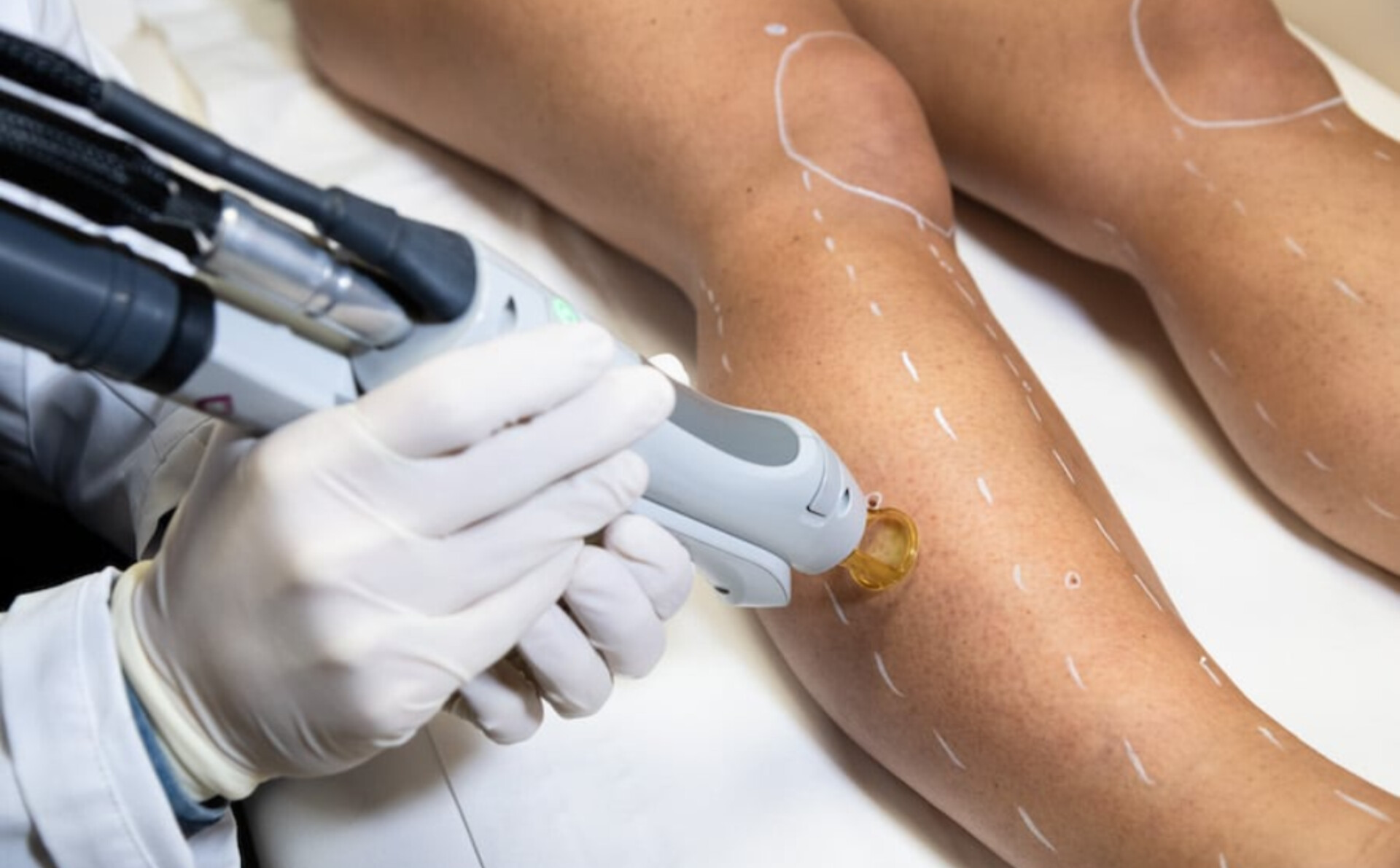 لیزر موهای زائد ساق پا بانوان با دستگاه دایود پلاس ۲۰۱۹ در مطب لیزر و زیبایی دکتر مونا معصوم آبادی (